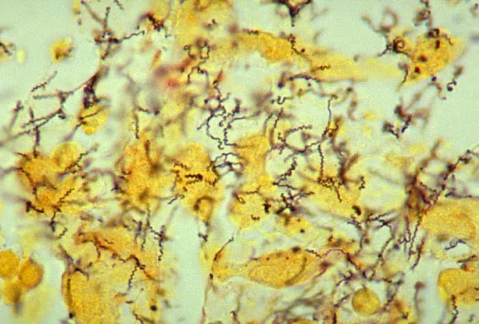 Genital Ulcer Sores in Male