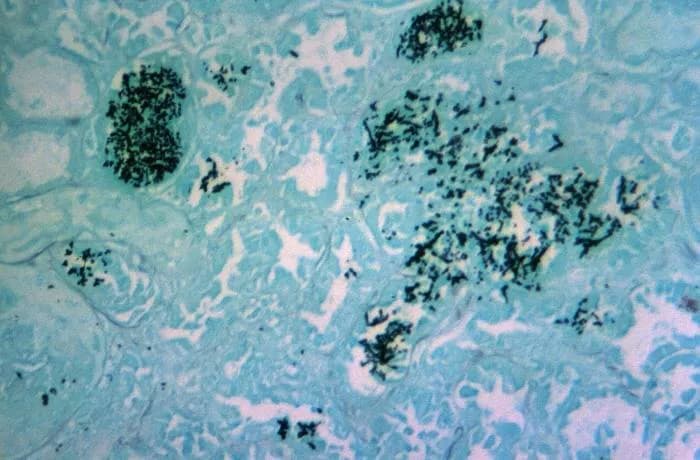 Candida Infection (Candidiasis)