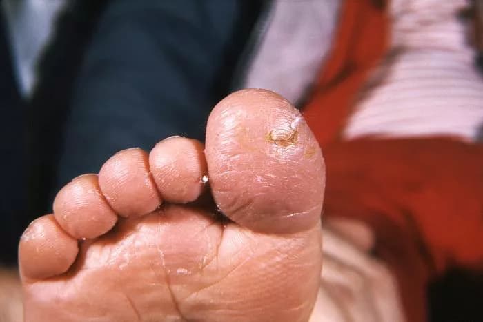 How To Prevent Fungal Skin Infections