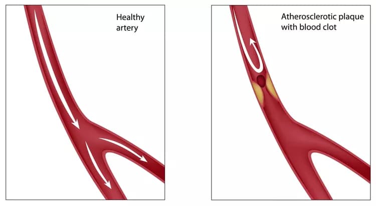 Hardening Of The Arteries