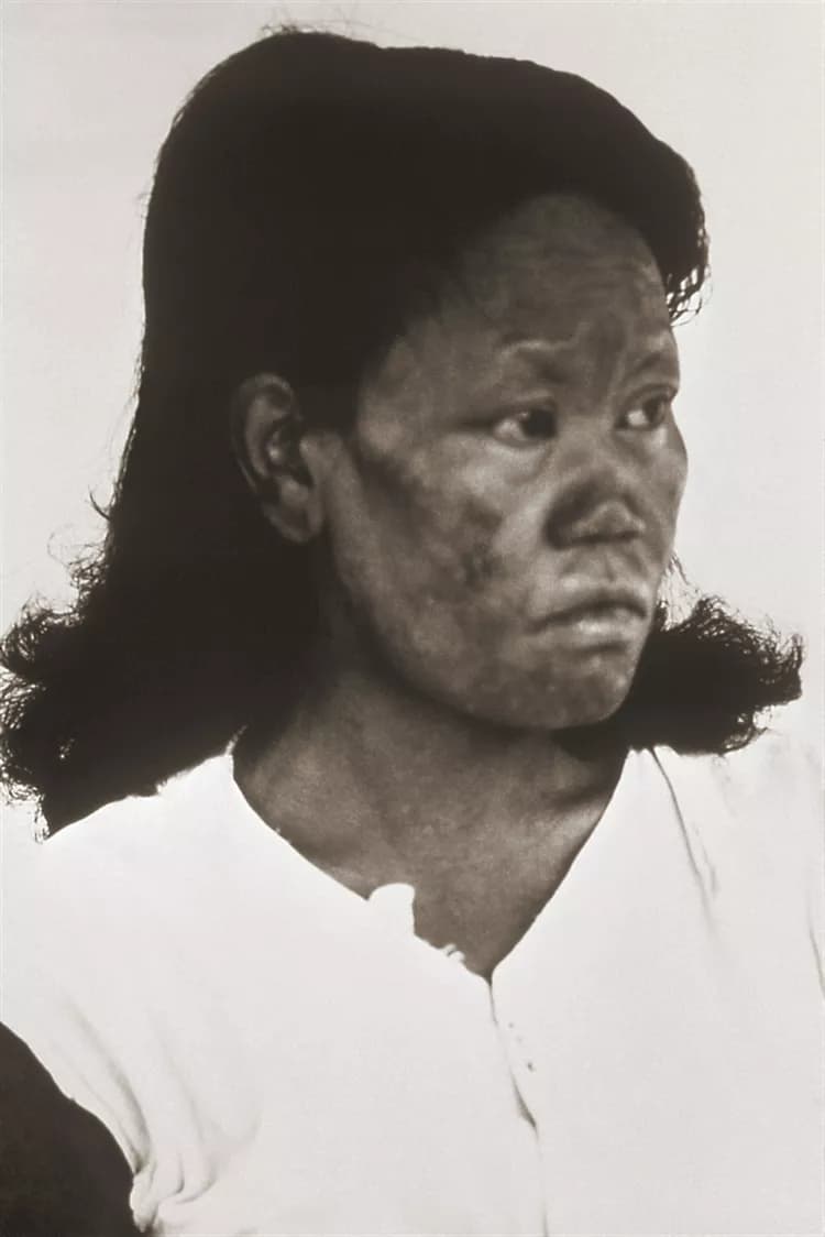 Leprosy