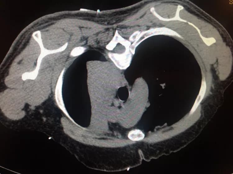 Non-Small Cell Lung Cancer