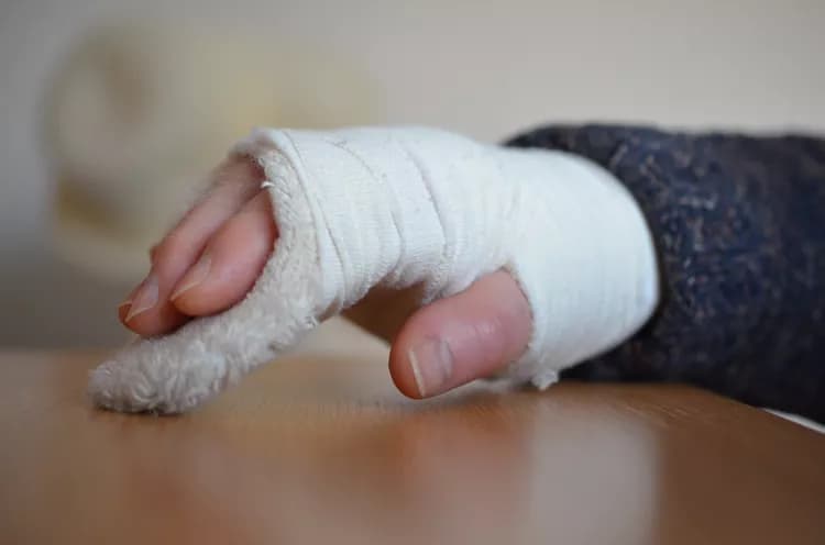 Plaster Cast