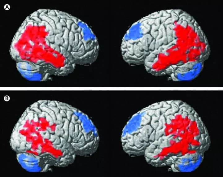 Reprinted from The Lancet, http://dx.doi.org/10.1016/S2215-0366(17)30076-7, Lipsman et al, Deep brain stimulation of the subcallosal cingulate for treatment-refractory anorexia nervosa: 1 year follow-up of an open-label trial, Copyright (2017), with permi