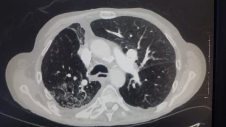 New Antibody Drug Conjugate Shows Early Promise in Small Cell Lung Cancer