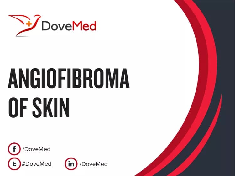 How well do you know Angiofibroma of Skin?