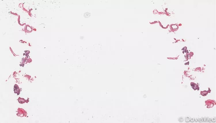 Is the cost to manage Basaloid Squamous Cell Carcinoma of Lung in your community affordable?