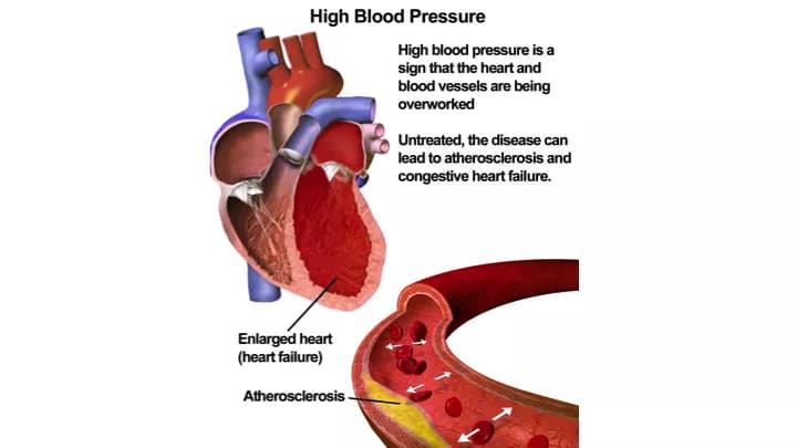 Blausen.com staff. "Blausen gallery 2014