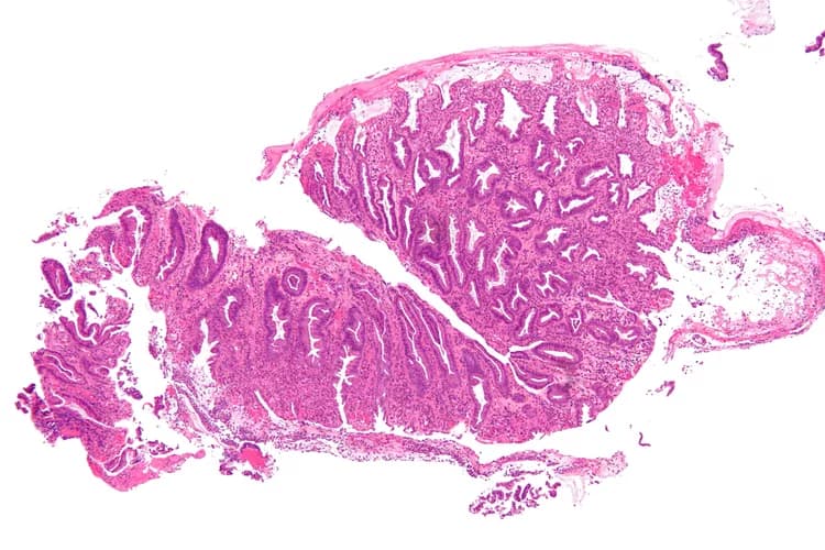 semaglutide and ischemic colitis blood in stool on Semaglutide-Associated a Patient Without Traditional Risk Factors: A Case Report Blood in Stool on Ozempic: Ischemic colitis on colonoscopy