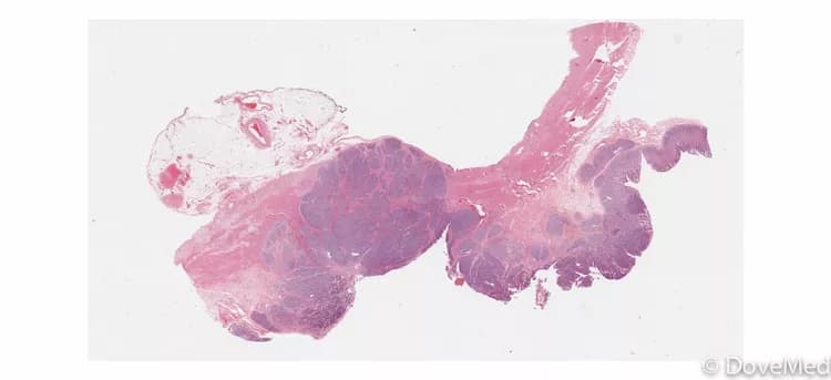 Can you access healthcare professionals in your community to manage Large Cell Neuroendocrine Carcinoma of Pancreas?