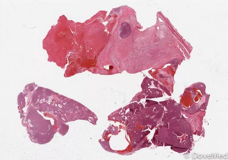 Leydig Cell Tumor of the Testis
