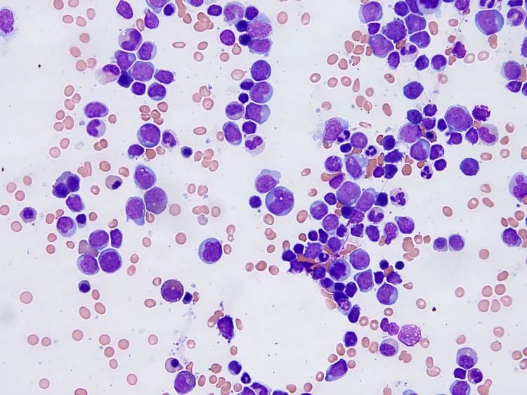 New Clue To Fighting Acute Myeloid Leukemia Found
