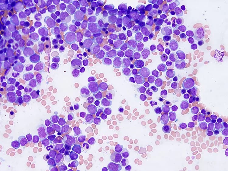 Facts about Leukemia and Lymphoma