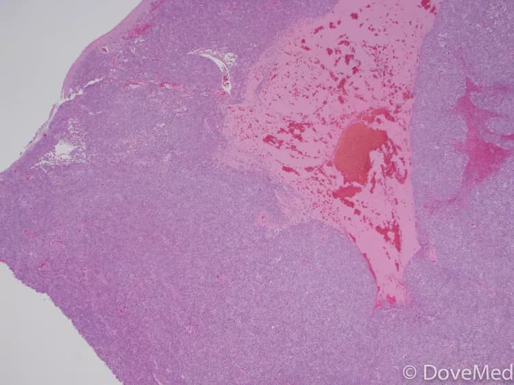 Leiomyosarcoma of Esophagus