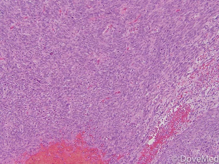 Leiomyosarcoma of Vulva