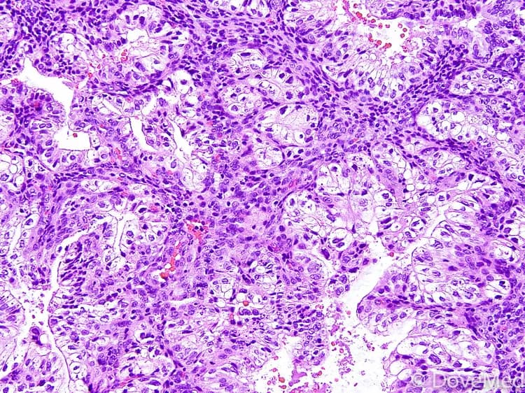 Glycogen-Rich Clear Cell Carcinoma of Breast