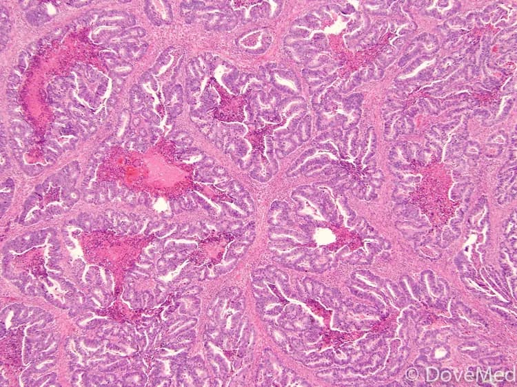 Solid Adenocarcinoma of Lung