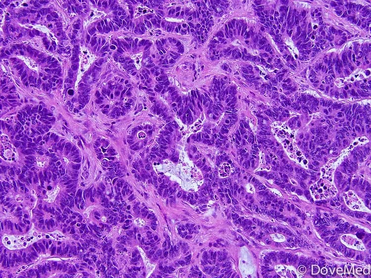 How well do you know Adenocarcinoma of Bartholin Gland?
