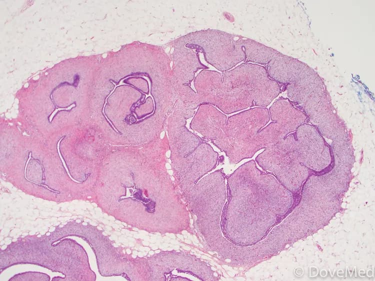 Fibroadenoma of Vulva