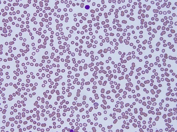 Hemoglobin Variants Blood Tests