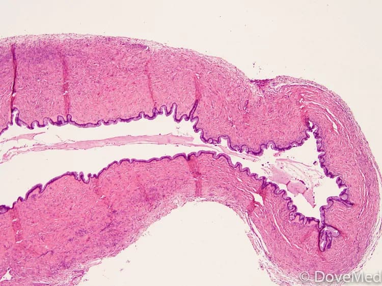 Benign Mucinous Cystadenoma of Ovary