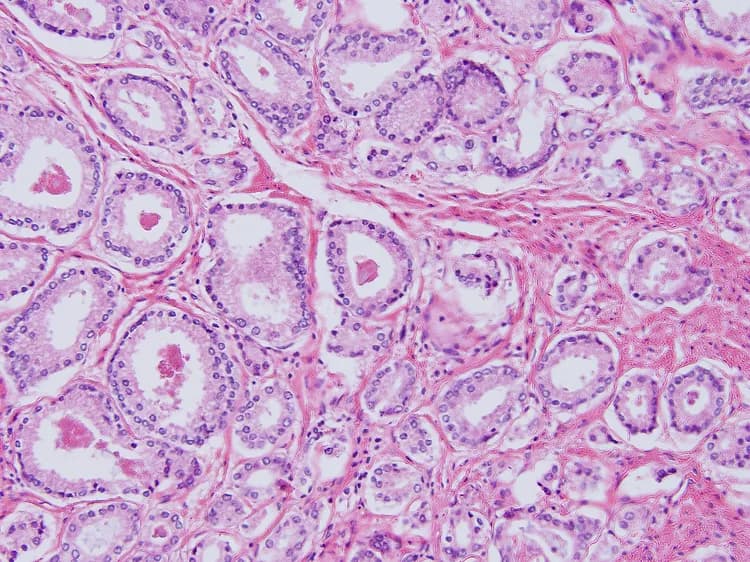 Prostate Cancer Discovery May Make It Easier To Kill Cancer Cells