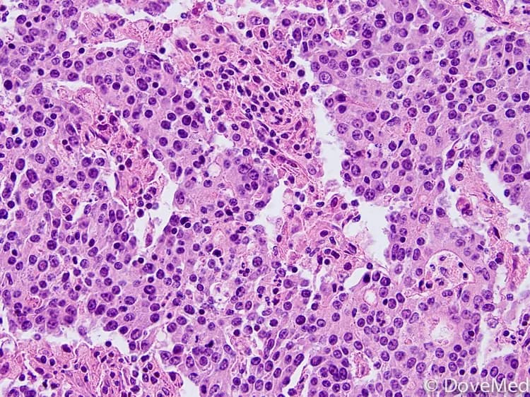 Microscopic image of a colon mass. What is your diagnosis?
