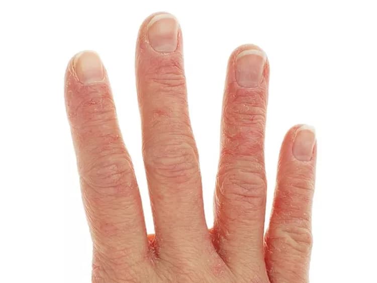 Eczema Can Have Many Effects On Patients' Health