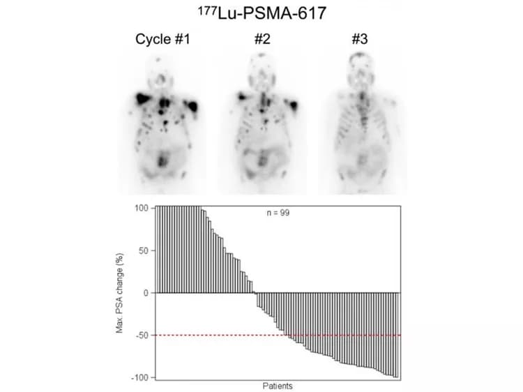 Kambiz Rahbar, M.D., Department of Nuclear Medicine, University Hospital Muenster, and Wolfgang Peter Fendler, M.D., Department of Nuclear Medicine, University Hospital Munich