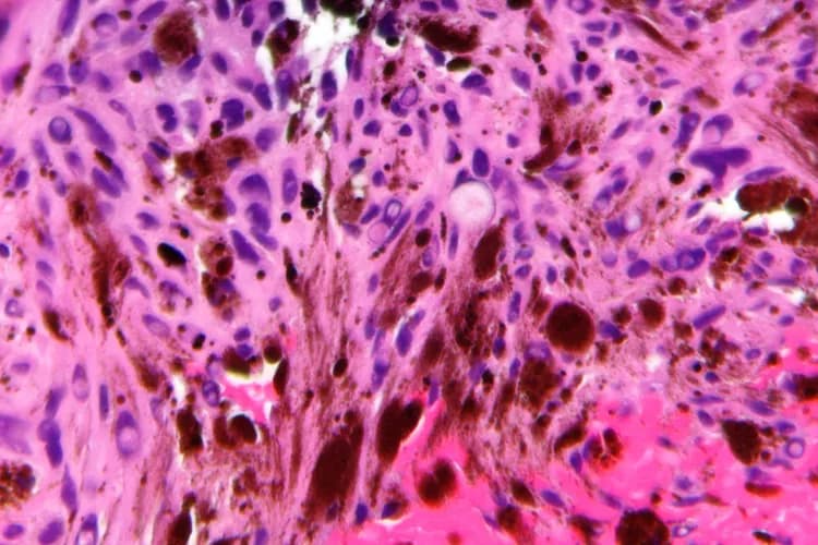 Psammomatous Melanotic Schwannoma - DoveMed Psammomatous Melanotic Schwannoma - DoveMed