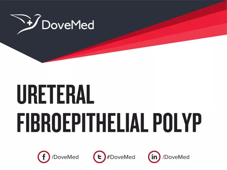 Ureteral Fibroepithelial Polyp