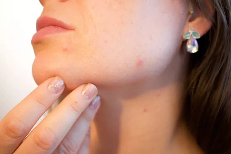 Can you access healthcare professionals in your community to manage Acne?