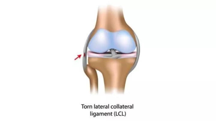 Lateral Collateral Ligament (LCL) Injury