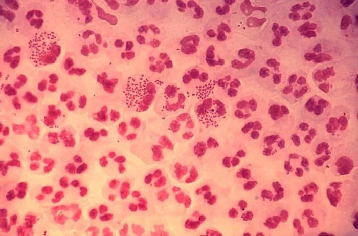 Europe Sees Constant Increase In Gonorrhea Infections