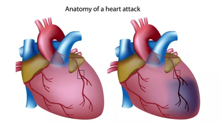 A Bioactive Molecule May Protect Against Congestive Heart Failure After Heart Attacks