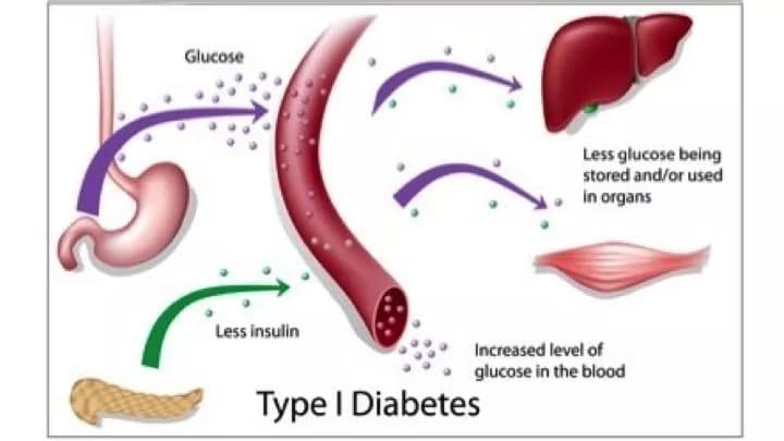 New Potential Cause Of Type 1 Diabetes