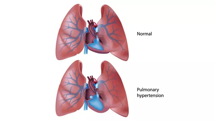 Pulmonary Hypertension (PH)