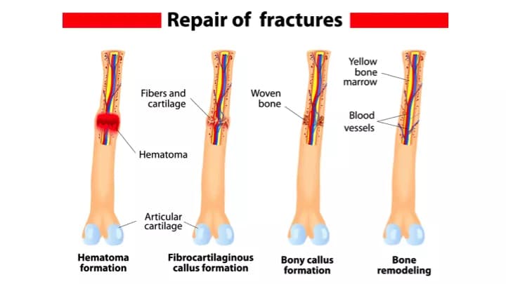 Fracture Repair