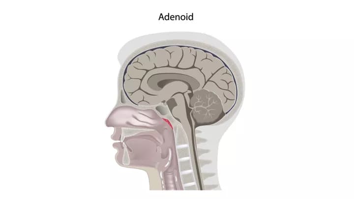 Adenoid Removal (Adenoidectomy)