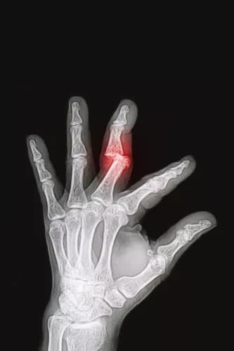 Facts about Finger Fracture