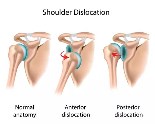 Facts about Chronic Shoulder Instability