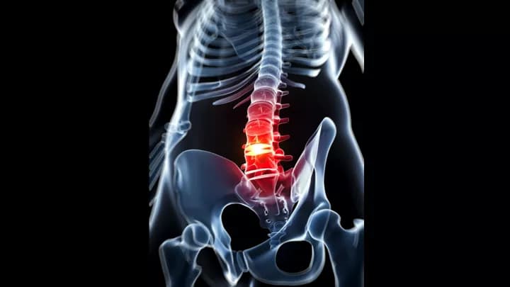 Facts about Herniated Disc