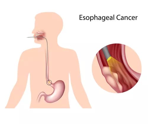 PET Scans Can Inform and Improve Treatment For Patients With Esophageal Cancer
