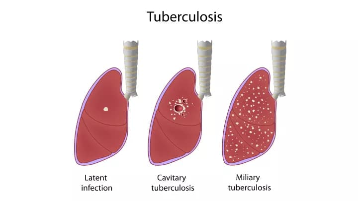 Double Strike Against Tuberculosis