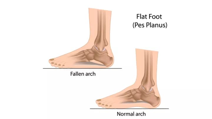 Facts about Adult (Acquired) Flatfoot