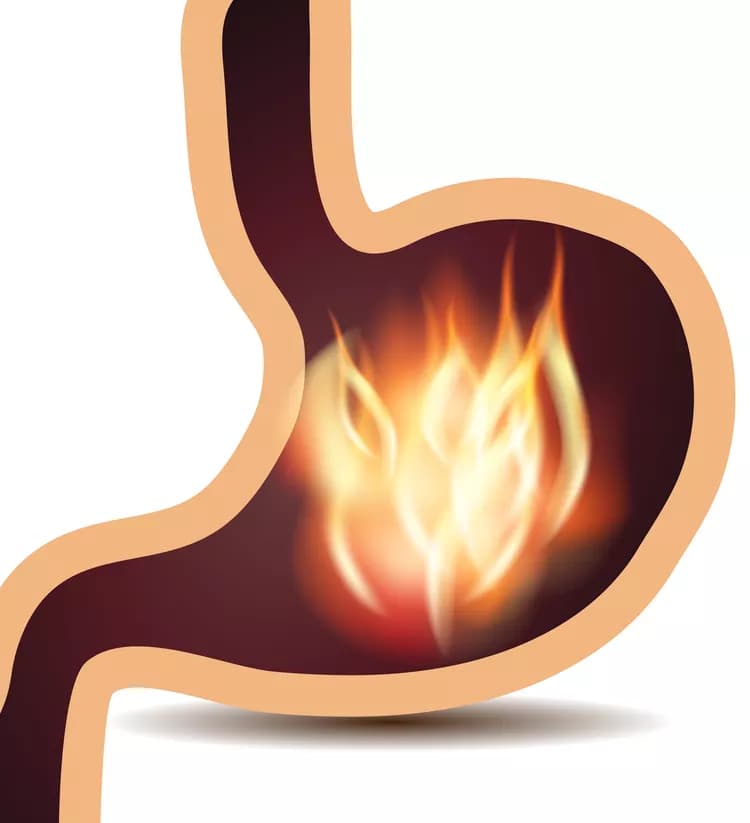 Facts about Acute Gastritis