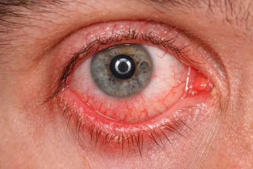 Facts about Bacterial Conjunctivitis