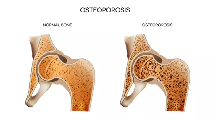 The Developmental Origins Of Osteoporosis