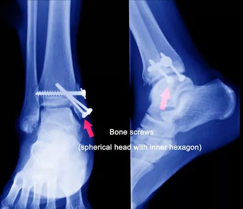 Ankle Fracture in Children
