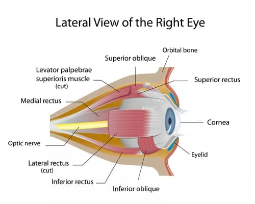 Which of the following is not a condition affecting the eye?
